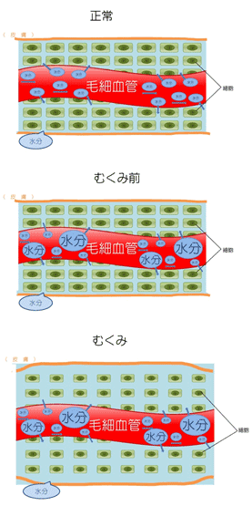 むくみのイメージ図